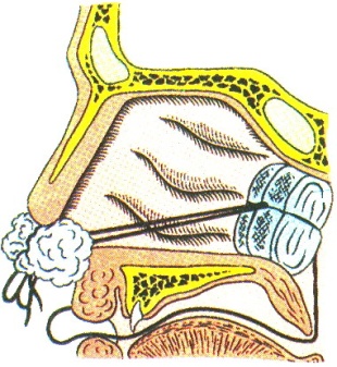 Заболевания полости носа - student2.ru