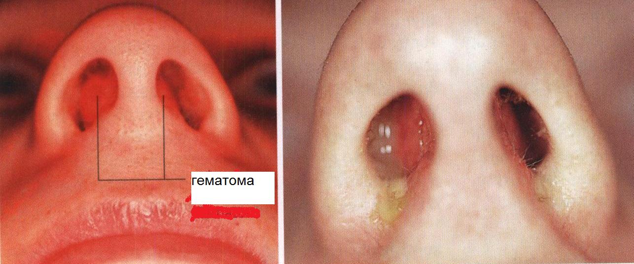 Заболевания полости носа - student2.ru