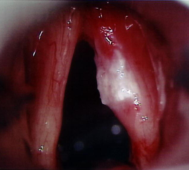 Злокачественные опухоли гортани - student2.ru