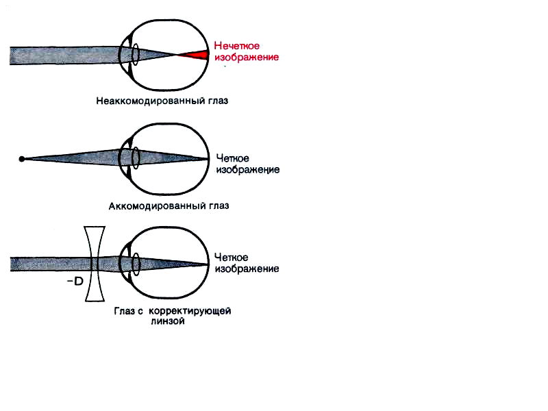 рефракция. нарушение рефракции (миопия и гиперметропия) - student2.ru