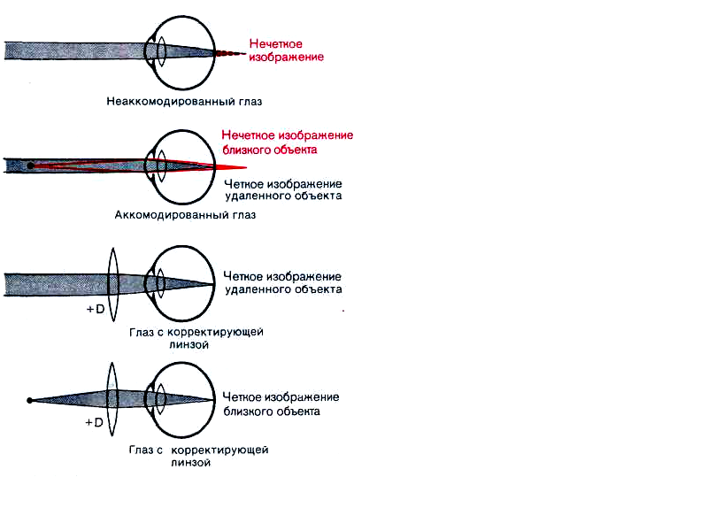 рефракция. нарушение рефракции (миопия и гиперметропия) - student2.ru