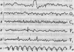 Электроэнцефалограмма и методы ее регистрации - student2.ru