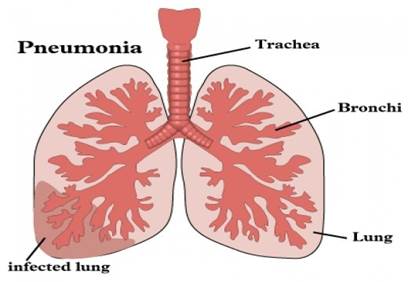 Section 3. Respiratory diseases in children - student2.ru