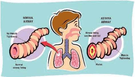 Section 3. Respiratory diseases in children - student2.ru