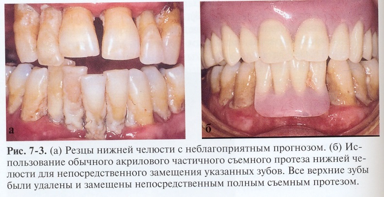 Адаптация к пластиночным протезам - student2.ru