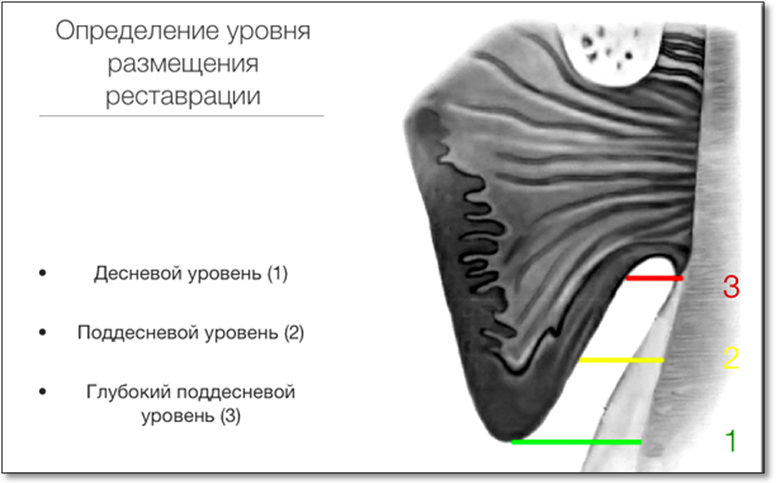 Финишная обработка уступа и осевых стенок культи. - student2.ru