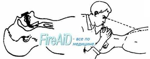 Искусственная вентиляция легких - student2.ru