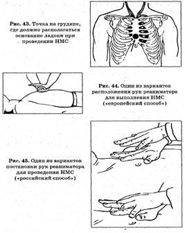 Наружный массаж сердца. Искусственная вентиляция лёгких - student2.ru