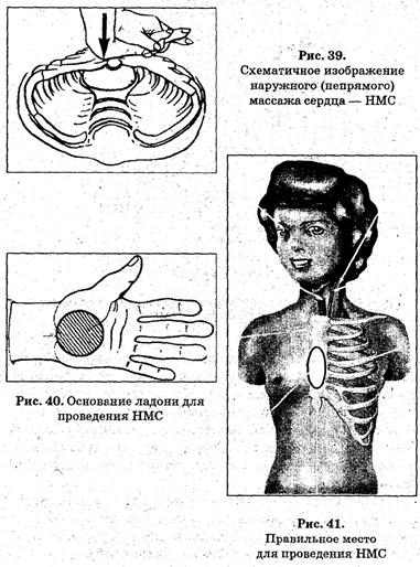 Наружный массаж сердца. Искусственная вентиляция лёгких - student2.ru