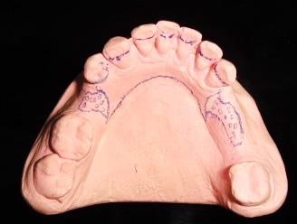 Показания к изготовлению пластиночных протезов с литым базисом - student2.ru