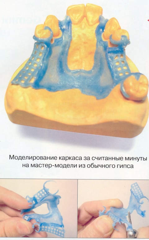 Показания к изготовлению пластиночных протезов с литым базисом - student2.ru