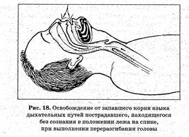 Причины непроходимости дыхательных путей и способы их устранения - student2.ru