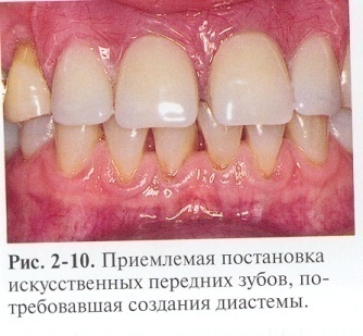 Проверка конструкции протеза в полости рта пациента - student2.ru