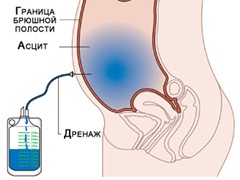 пункция брюшной полости - student2.ru