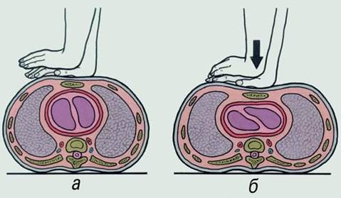 Техника проведения непрямого массажа сердца - student2.ru