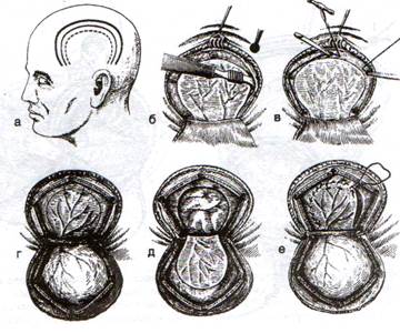 Трепанация черепа с образованием кожного и костно-надкостнично-мышечного лоскута. Костно-пластический и резекционный методы - student2.ru