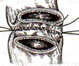 Ушивание ран кишечника - student2.ru
