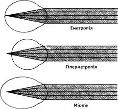 Аномалії рефракції ока - student2.ru