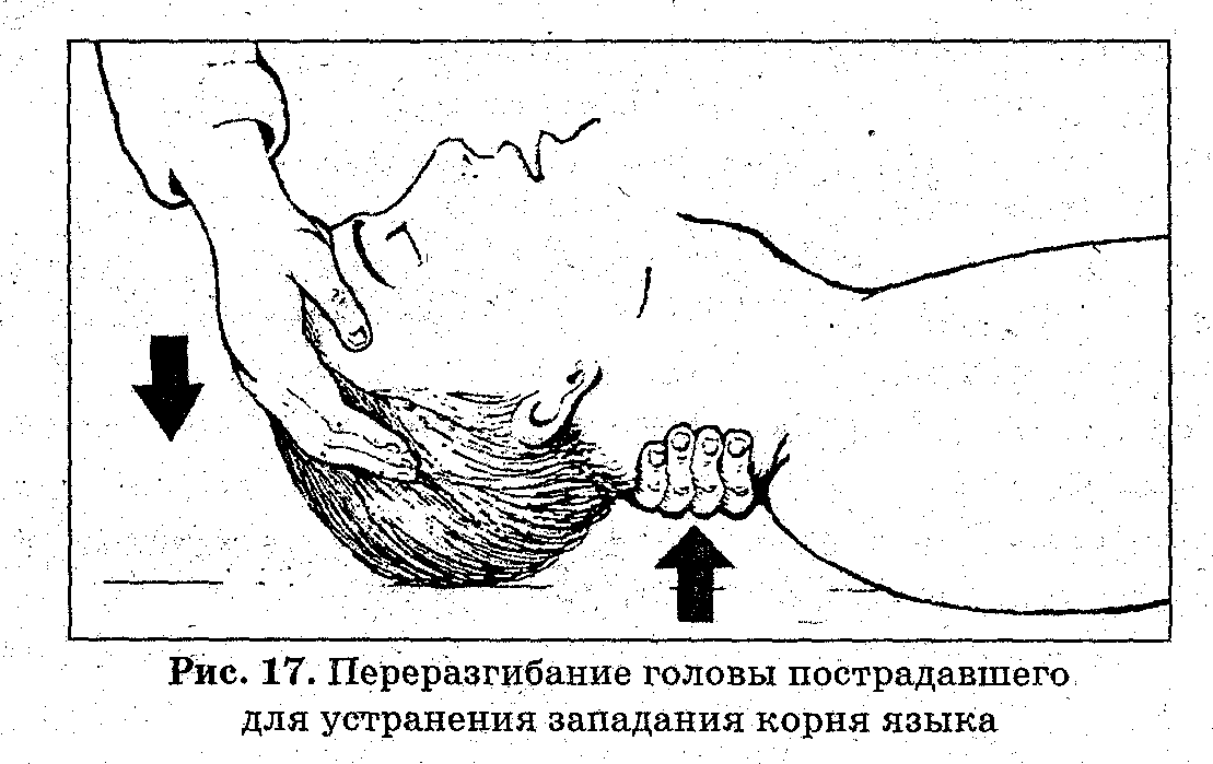 Продемонстрировать способы удаления инородного тела из дыхательных путей у взрослых. Прием Хаймлика. - student2.ru