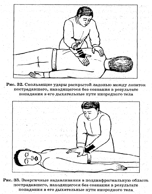 Продемонстрировать способы удаления инородного тела из дыхательных путей у взрослых. Прием Хаймлика. - student2.ru