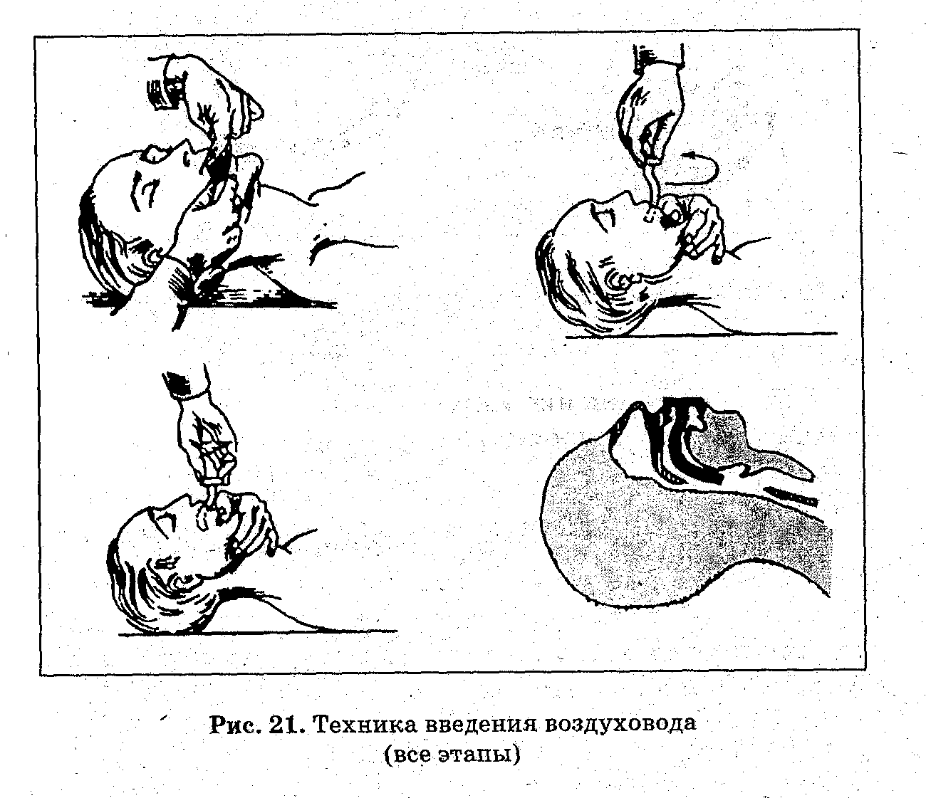 Продемонстрировать способы удаления инородного тела из дыхательных путей у взрослых. Прием Хаймлика. - student2.ru