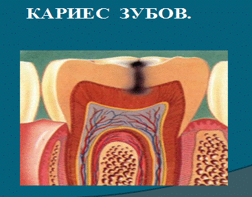 Теории происхождения кариеса зубов - student2.ru