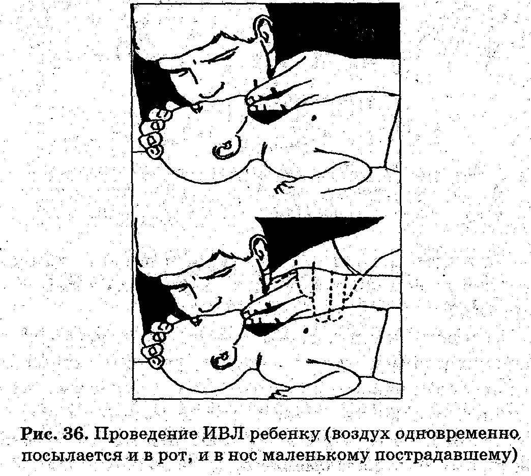 Выполните непрямой массаж сердца и искусственную вентиляцию легких ребенку (до 1 года). - student2.ru