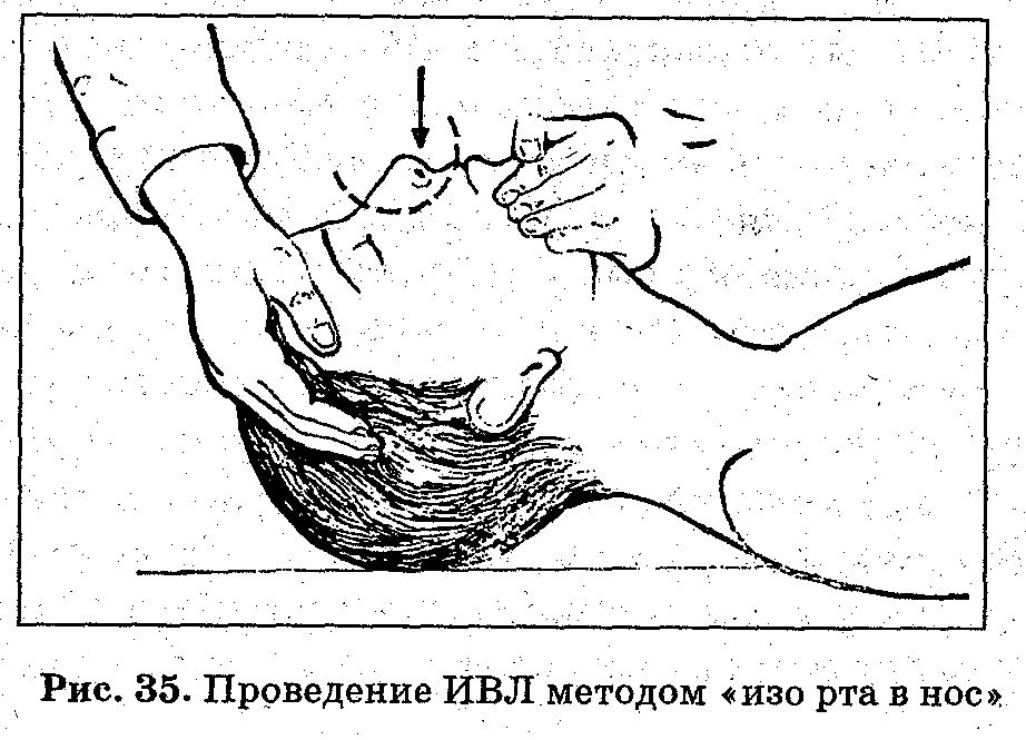 Выполните непрямой массаж сердца и искусственную вентиляцию легких ребенку (до 1 года). - student2.ru