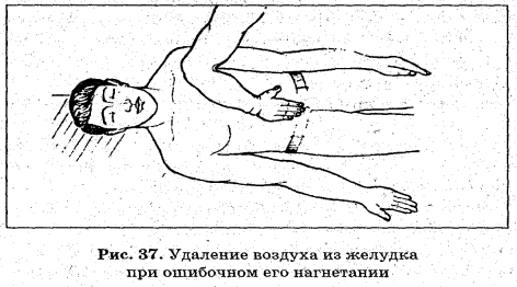 Выполните непрямой массаж сердца и искусственную вентиляцию легких ребенку (до 1 года). - student2.ru