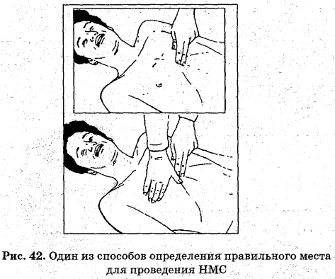 Выполните непрямой массаж сердца и искусственную вентиляцию легких ребенку (до 1 года). - student2.ru