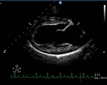 В-режим (двухмерная эхокардиография, секторальное сканирование) - student2.ru