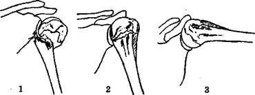 Лечение переломов хирургической шейки плечевой кости - student2.ru