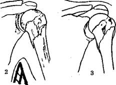 Лечение переломов хирургической шейки плечевой кости - student2.ru