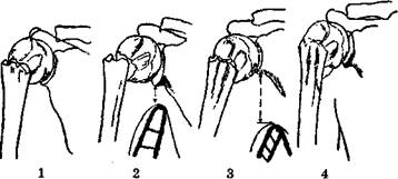Лечение переломов хирургической шейки плечевой кости - student2.ru