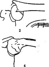 Лечение переломов хирургической шейки плечевой кости - student2.ru