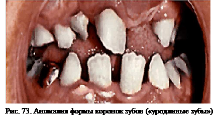 Аномалии величины, формы и структуры твердых тканей зубов - student2.ru