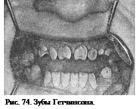 Аномалии величины, формы и структуры твердых тканей зубов - student2.ru