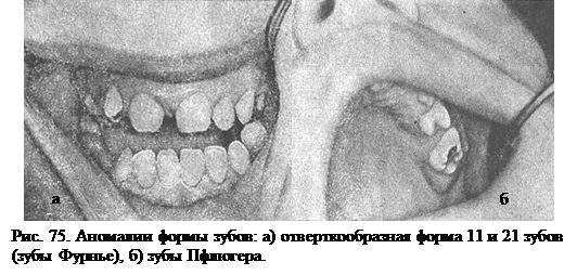 Аномалии величины, формы и структуры твердых тканей зубов - student2.ru