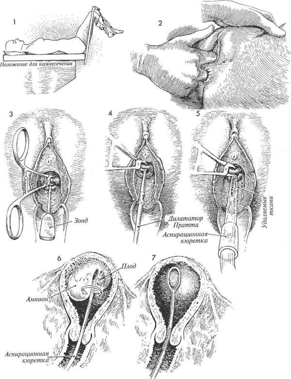аспирационный кюретаж для прерывания - student2.ru