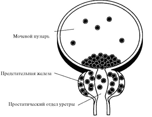 Доброкачественная гиперплазия предстательной железы - student2.ru