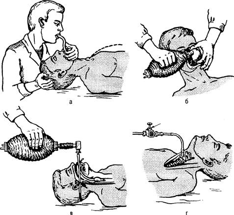 ИСКУССТВЕННАЯ ВЕНТИЛЯЦИЯ ЛЕГКИХ. Об эффективности любого способа ИВЛ («изо рта в рот», «изо рта в нос») судят по тому, насколько полно восстановлена проходимость дыхательных путей. - student2.ru