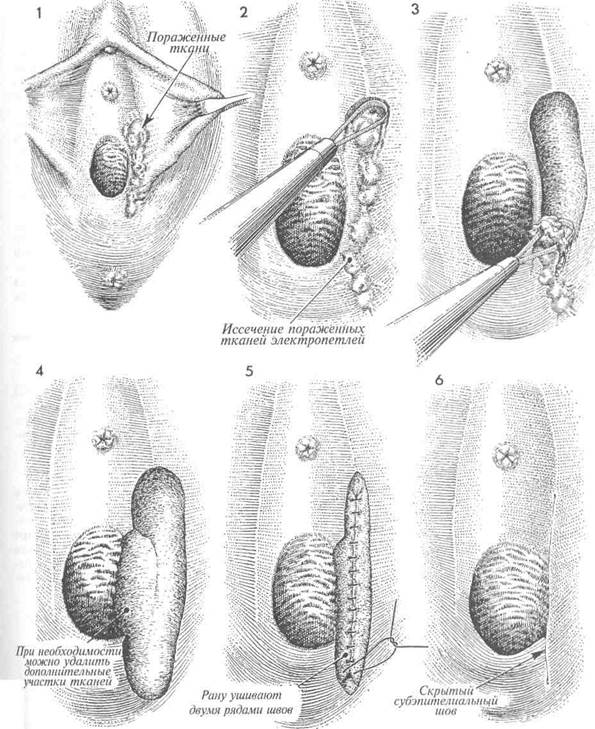 иссечение участков вульвы электропетлей - student2.ru