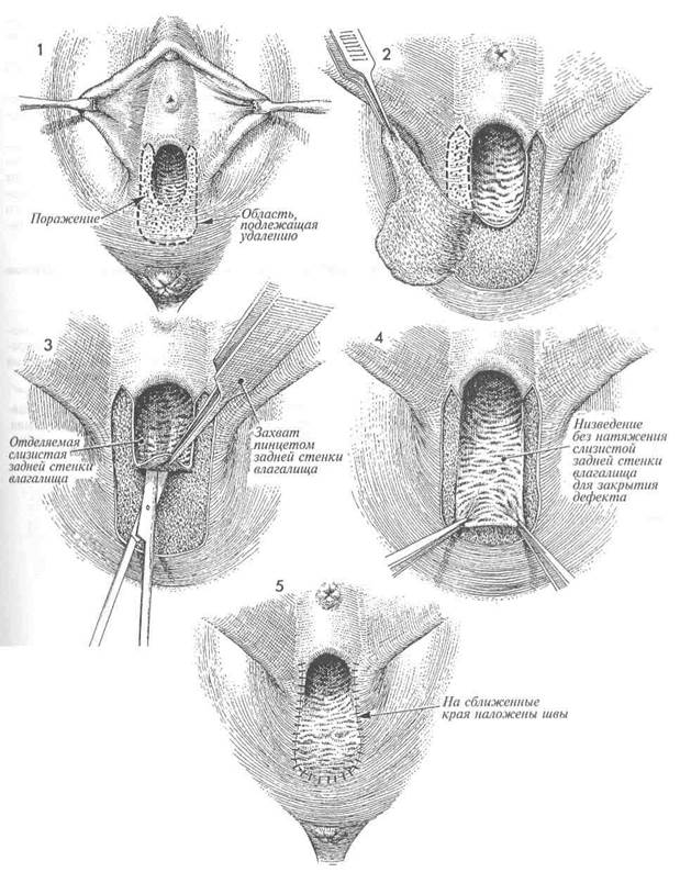 иссечение участков вульвы электропетлей - student2.ru