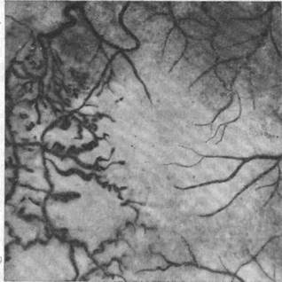 изменения сосудов сетчатки и сосудистой оболочки глазного яблока при оценке активности некоторых форм туберкулеза глаз - student2.ru