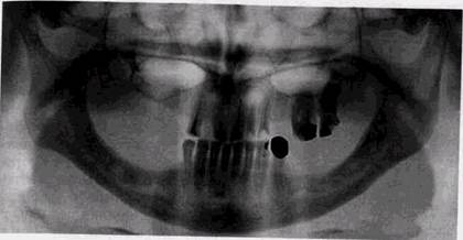 кисты челюстных костей в рентгенологическом изображении - student2.ru