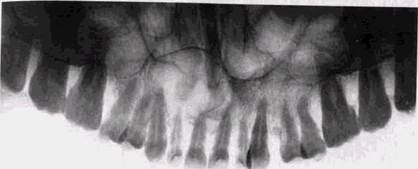 кисты челюстных костей в рентгенологическом изображении - student2.ru
