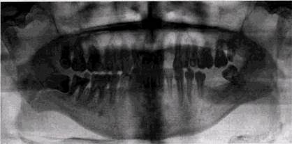 кисты челюстных костей в рентгенологическом изображении - student2.ru