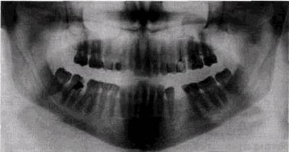 кисты челюстных костей в рентгенологическом изображении - student2.ru