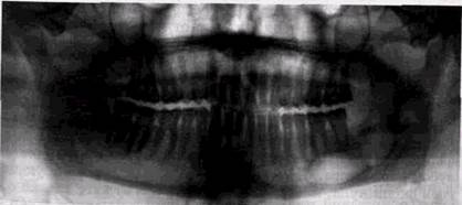 кисты челюстных костей в рентгенологическом изображении - student2.ru