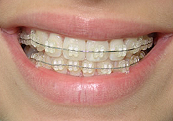 Классификация дефектов зубных рядов - student2.ru
